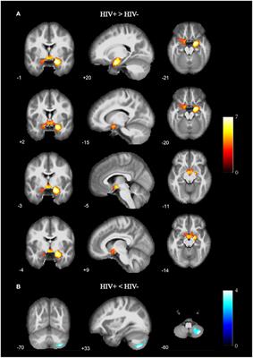 HIV-Associated Structural and Functional Brain Alterations in Homosexual Males